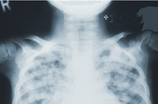 Salud cardiorespiratoria con fisioterapia